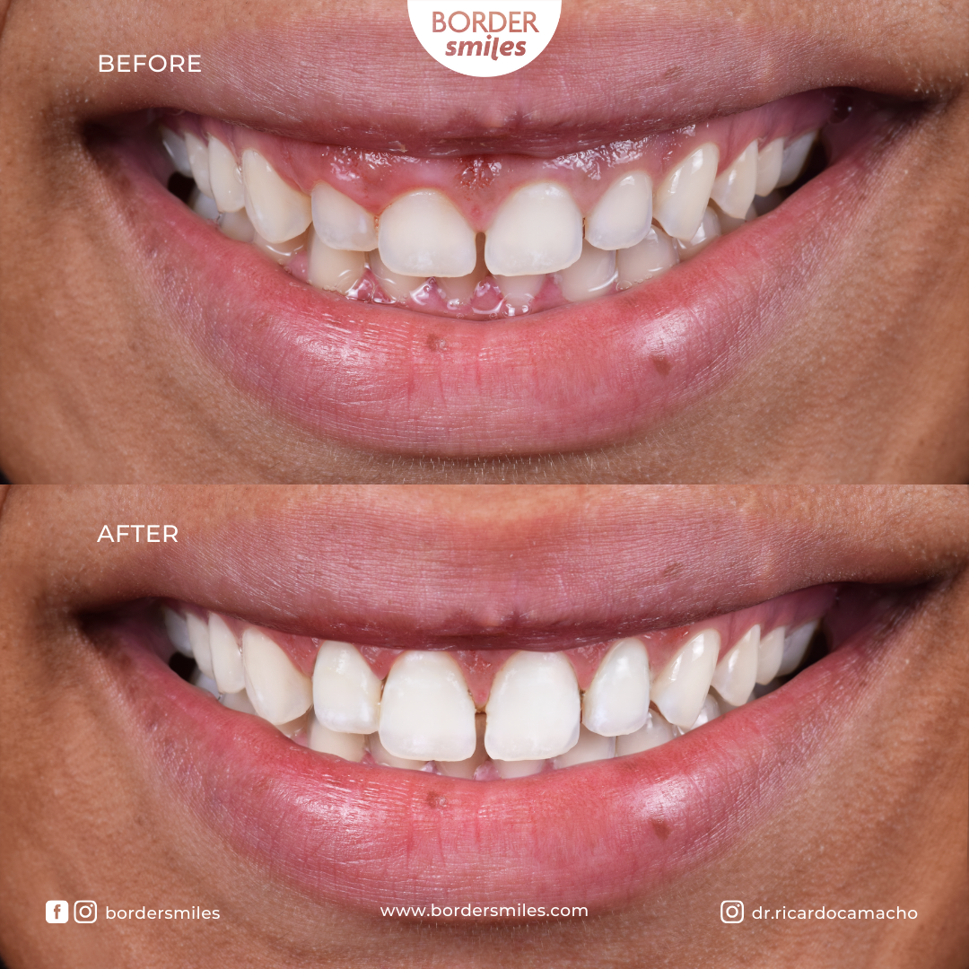 Sonrisa Gingival