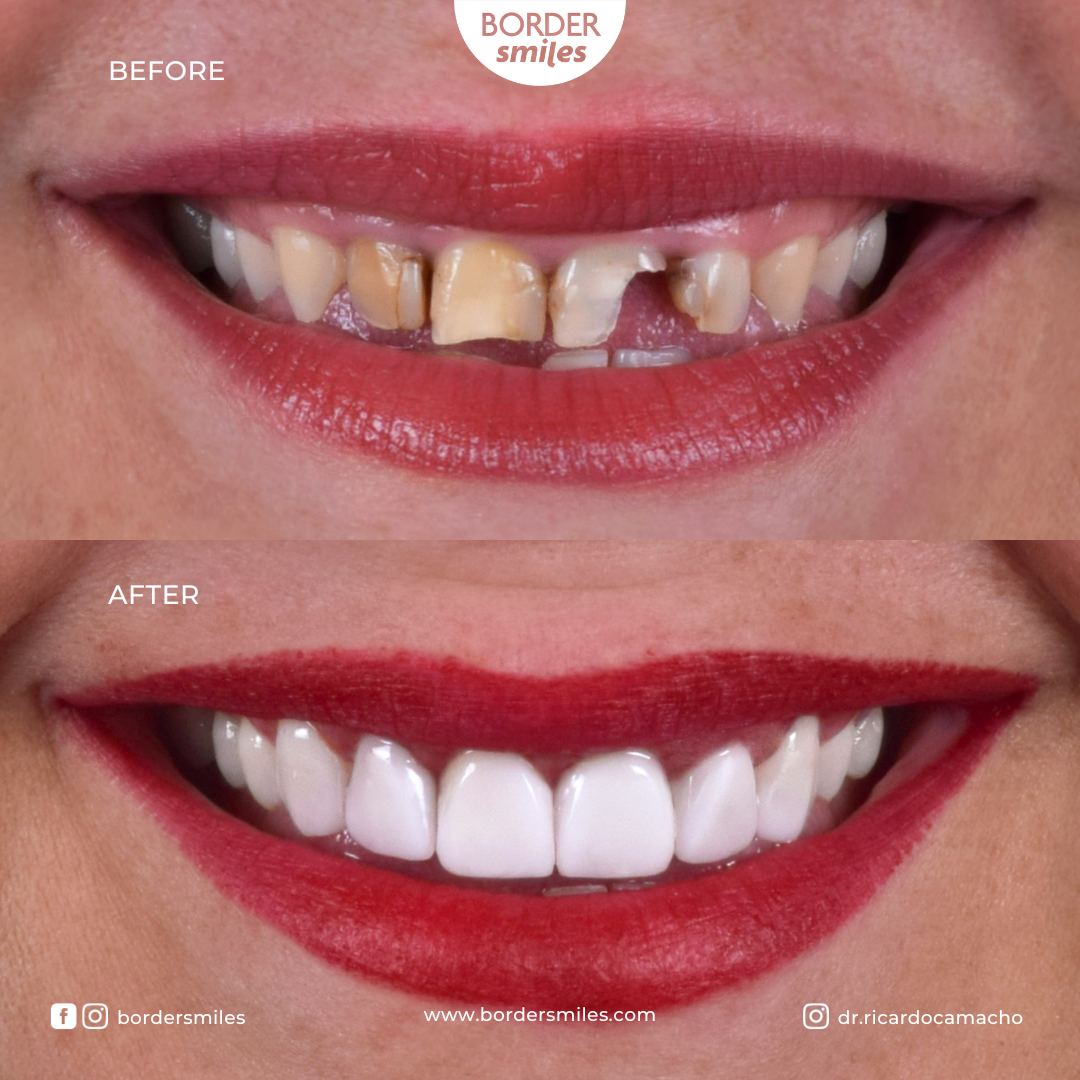 ¡Un Smile Makeover es lo que necesitas para volver a sonreír!